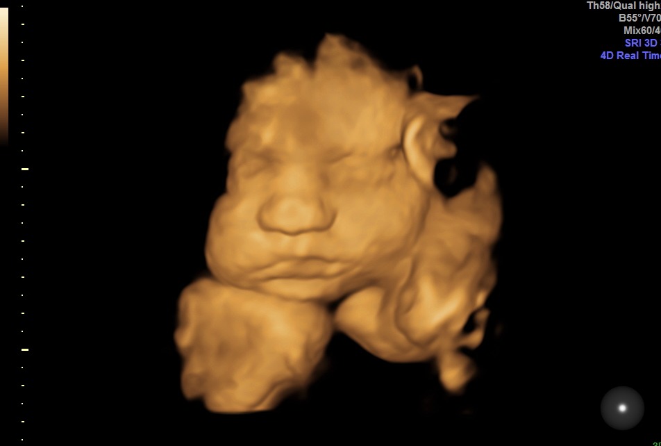 3D Ultrasound Gallery: See Your Baby in Stunning HD | BabyLove Ultrasound